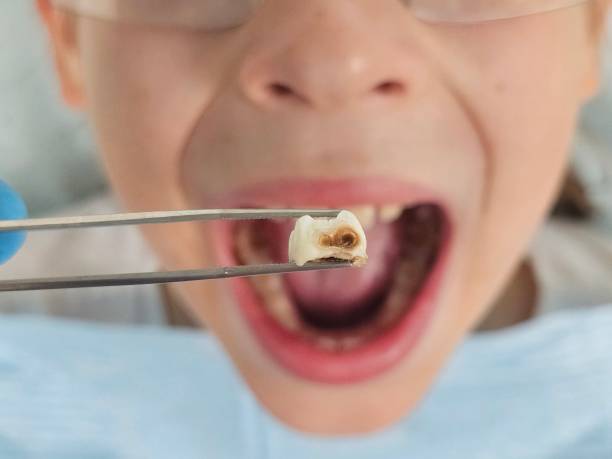 Best Emergency Treatment for Dental Infections or Abscesses in Garden Grove, FL