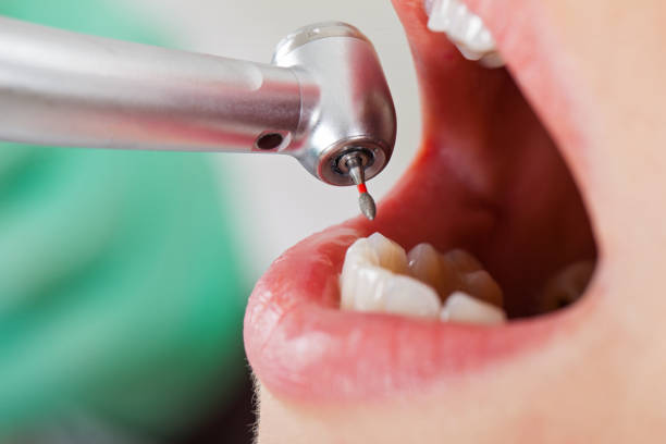 Best Emergency Tooth Extraction in Garden Grove, FL